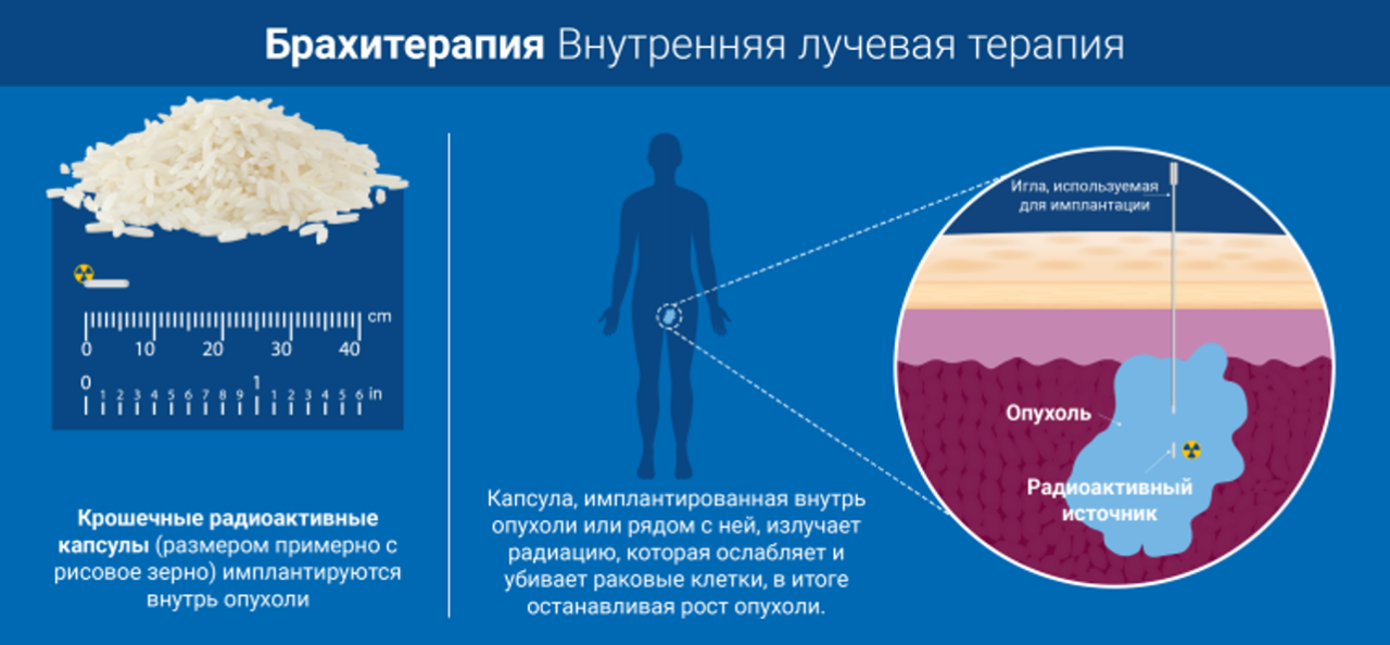 Брахитерапия часто используется для лечения рака простаты, молочной железы, кожи и некоторых видов опухолей в области головы и шеи МАГАТЭ
