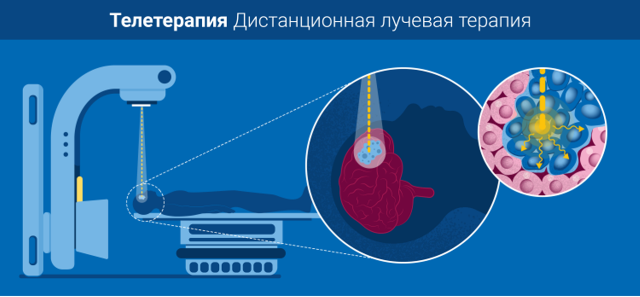 Дистанционная лучевая терапия используется для лечения многих видов опухолей, в том числе в областях головы, шеи, груди, легких или толстой кишки МАГАТЭ